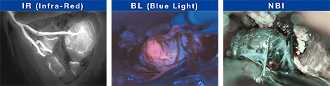 IR（Infra-Red）、BL（Blue Light）、NBIの画像