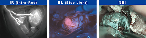 IR(Infra-Red)、BL(Blue Light)、NBIの画像